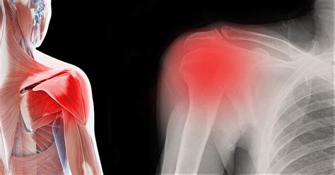 Best Frozen Shoulder Treatment Options For Lasting Pain Relief