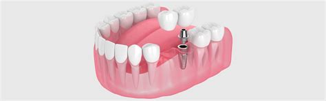 What is the difference between a Permanent and a Temporary Dental Bridge?