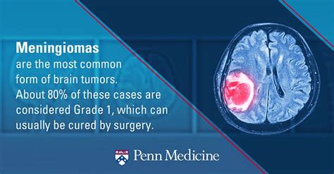 Meningioma: causes, symptoms and treatments – Healthy Food Near Me