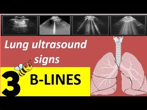 B lines /lung ultrasound signs - YouTube