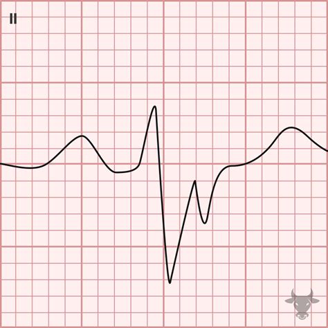 Bifascicular Block | ECG Stampede