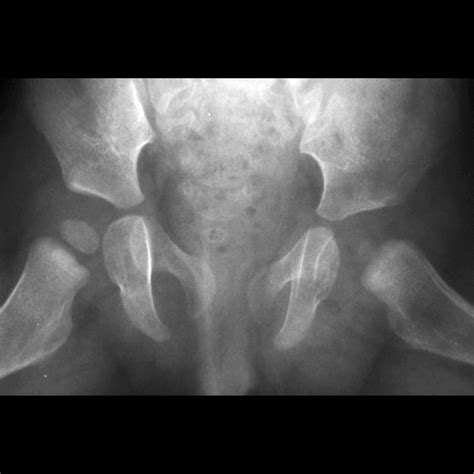 Congenital Hip Dysplasia Radiology