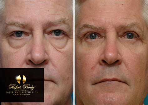 Ultherapy Laser Skin Tightening For The Face - Perfect Body Laser ...