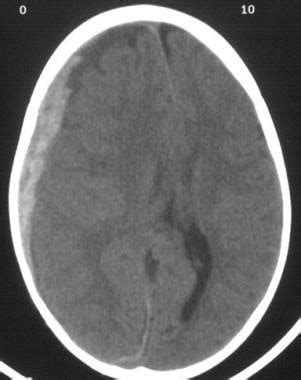 Subdural Hematoma: Background, Pathophysiology, Etiology