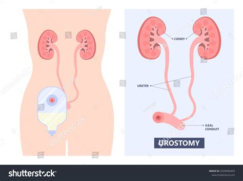 Ileal conduit 사진 및 이미지 | Shutterstock