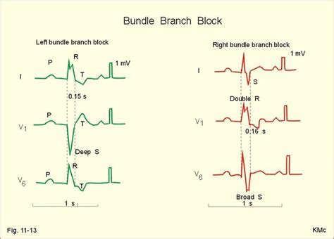 Bundle Branch Block