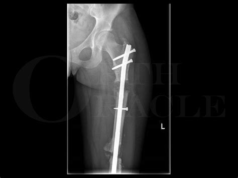 Share 123+ retrograde femoral nail - in.coedo.com.vn