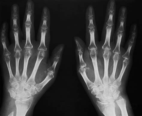 X Ray Image Of Left Hand