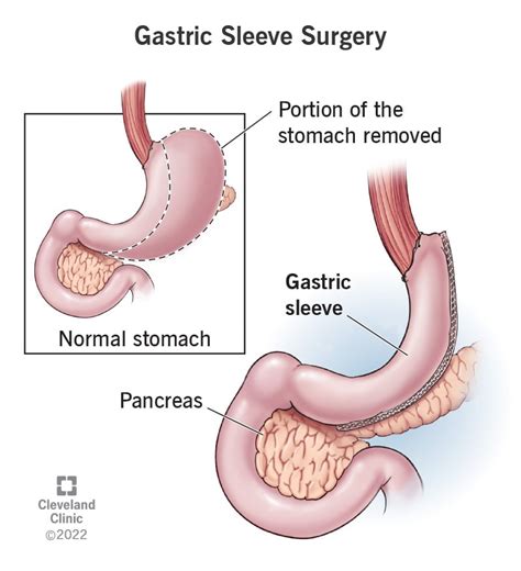 Gastric Sleeve Surgery: What it Is, Requirements