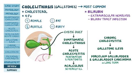 Cholelithiasis: What Is It, Causes, Treatment, and More | Osmosis