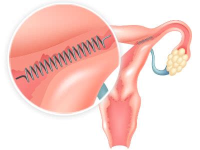 Problemas Essure Bayer - Marcus Reid