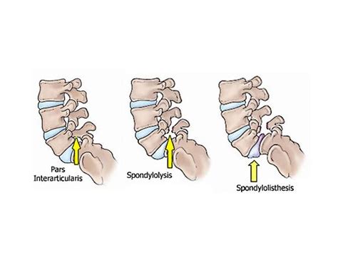 Spondylolisthesis & Spondylolysis Causes And Best Treatment