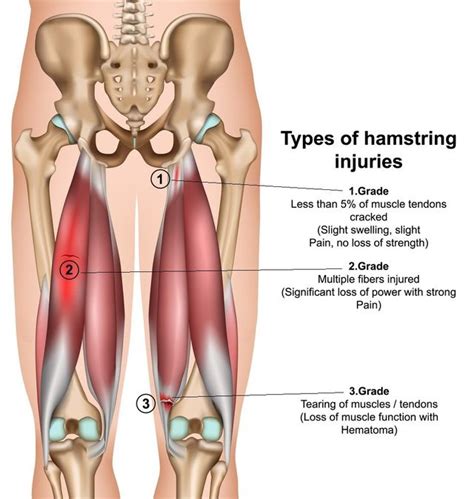 Hamstring Tendon Popping