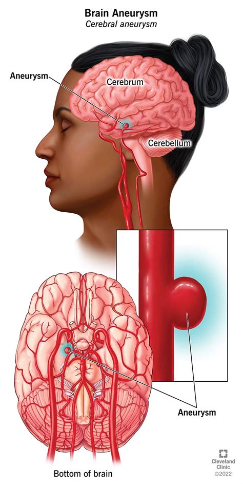 Brain Aneurysm: What It Is, Causes, Symptoms & Treatment