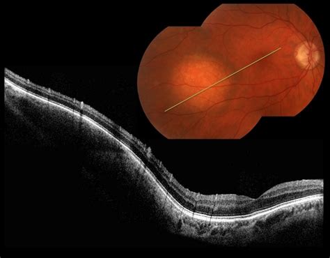 choroidal hemangioma - Retina Image Bank