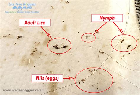 Head Lice: How to Identify Head Lice and Nits