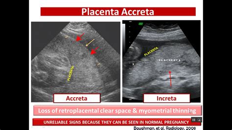 Placenta lesions imaging | Fetal abnormalities, Ultrasound sonography ...