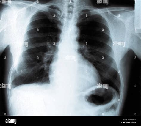 chest x-ray of a smoker man Stock Photo - Alamy