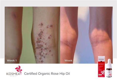 Rosehip Oil Before and Afters - Our Natural Skin Care Products | Kosmea