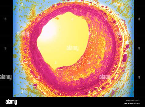 ATHEROMA, HISTOLOGY Stock Photo - Alamy