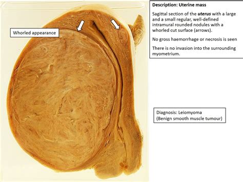 Neoplasia – Exercises! – NUS Pathweb :: NUS Pathweb