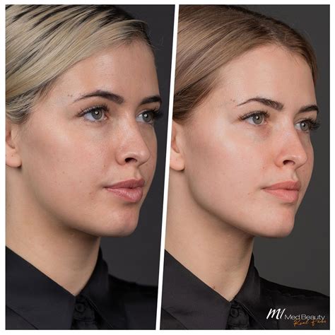 Cheek Enhancement with Dermal Fillers – M1 Med Beauty Australia