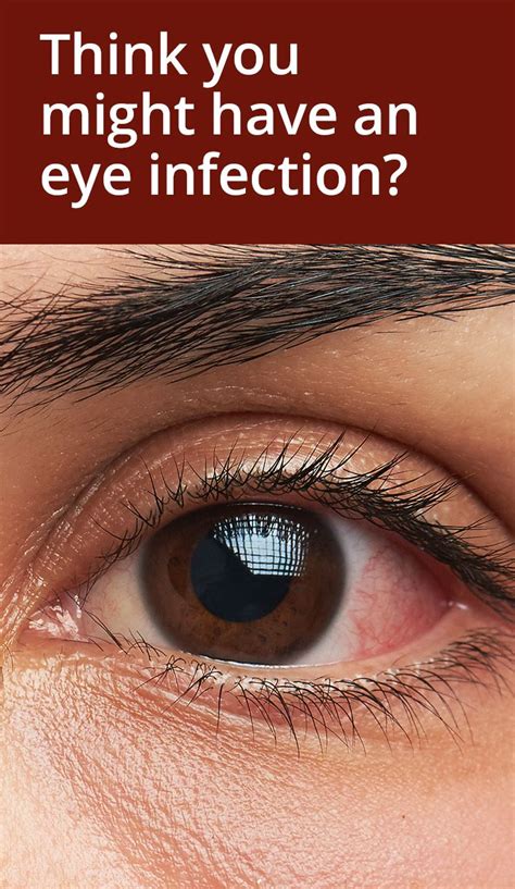 How to Tell if You Have an Eye Infection | Eye infections, Bacterial ...