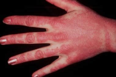 Dermatomyositis: Practice Essentials, Background, Pathophysiology