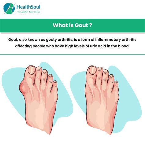 Gout: Causes, Symptoms and Treatment – Healthsoul