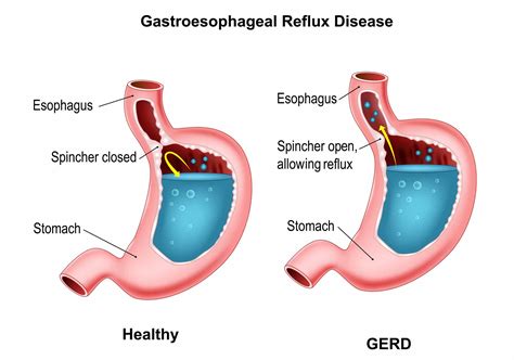 Hiatal Hernia Surgery in Katy, TX | Dr. Clay Albrecht