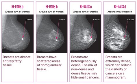 BreastScreen SA • Breast density