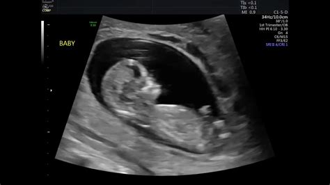 12 WEEK ULTRASOUND! MY BABY MOVING & HEARTBEAT! - YouTube