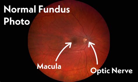 What does a Fundus Photo capture and why may it be necessary ...