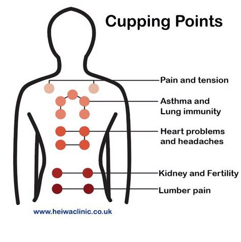 Cupping Therapy for better health | Cupping therapy, Cupping points ...