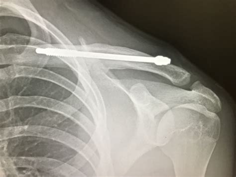 Proximal Clavicle Fracture