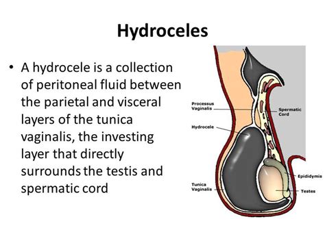 How To Treat Varicocele Naturally | carfare.me 2019-2020