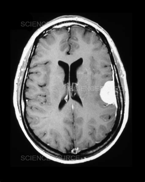 MRI of Meningioma | Stock Image - Science Source Images