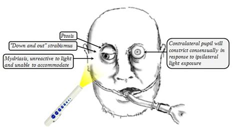 Cranial Nerve 3 Palsy