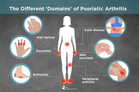 Different Types of Psoriatic Arthritis: Symptoms, Treatments, Outcomes