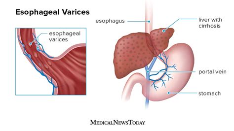 What are esophageal varices? Types, treatments, and more