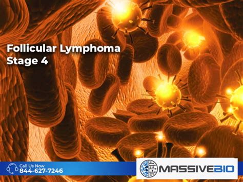 Follicular Lymphoma Stage 4 - Types, Symptoms, Treatment - Massive Bio