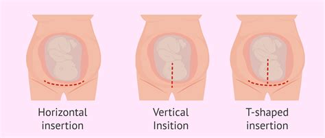 Cesarean Section Anatomy