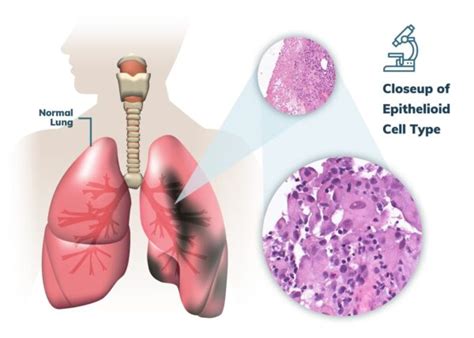 Pleural Mesothelioma | Treatment, Prognosis & Survival