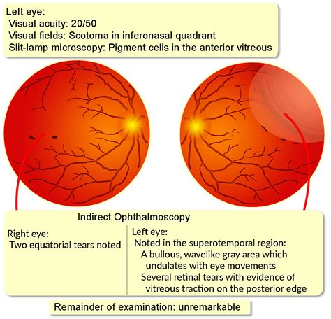 Retinal Detachment, Rhegmatogenous - Interactive case study | Clinical ...