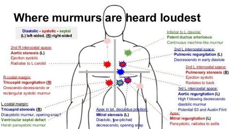 mitral stenosis murmur - Google Search