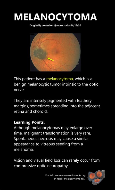 Optic Nerve Disorders > Melanocytoma - Retina Rocks