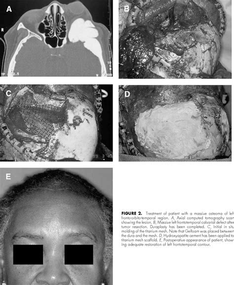 Figure 2 from Titanium mesh and hydroxyapatite cement cranioplasty: a ...