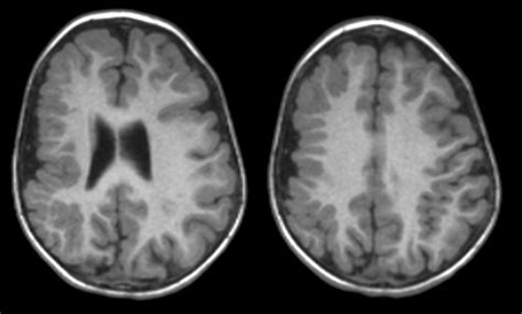 Lissencephaly4