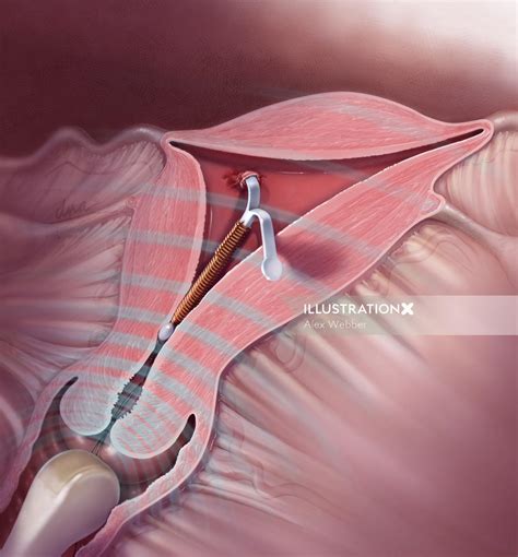 Removal of Embedded IUD | Illustration by Alex Webber