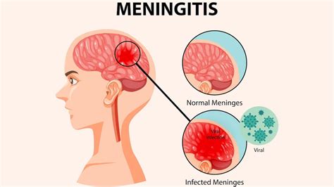 15 Interesting Facts About Meningitis - Facts.net